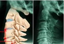 Mga ehersisyo para sa paggamot ng spinal osteochondrosis